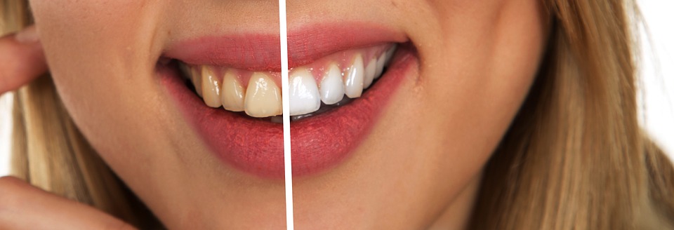 Top Teeth Whitening Misconceptions