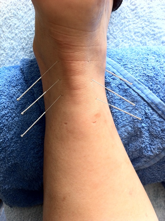 An Outlook Into Acupuncture Spring Hill