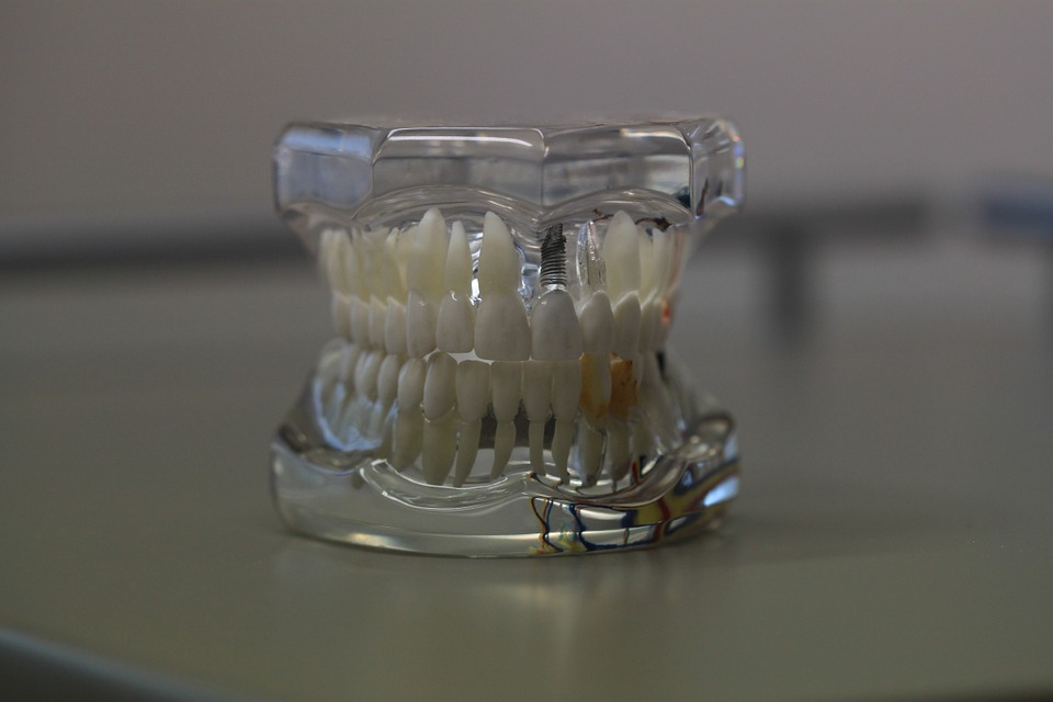 Complete Dentures Brisbane North Can Give You A New Smile