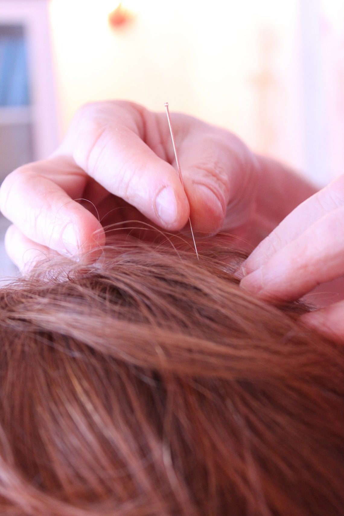 Acupuncture: A Natural Remedy for Pain Relief in West Ryde