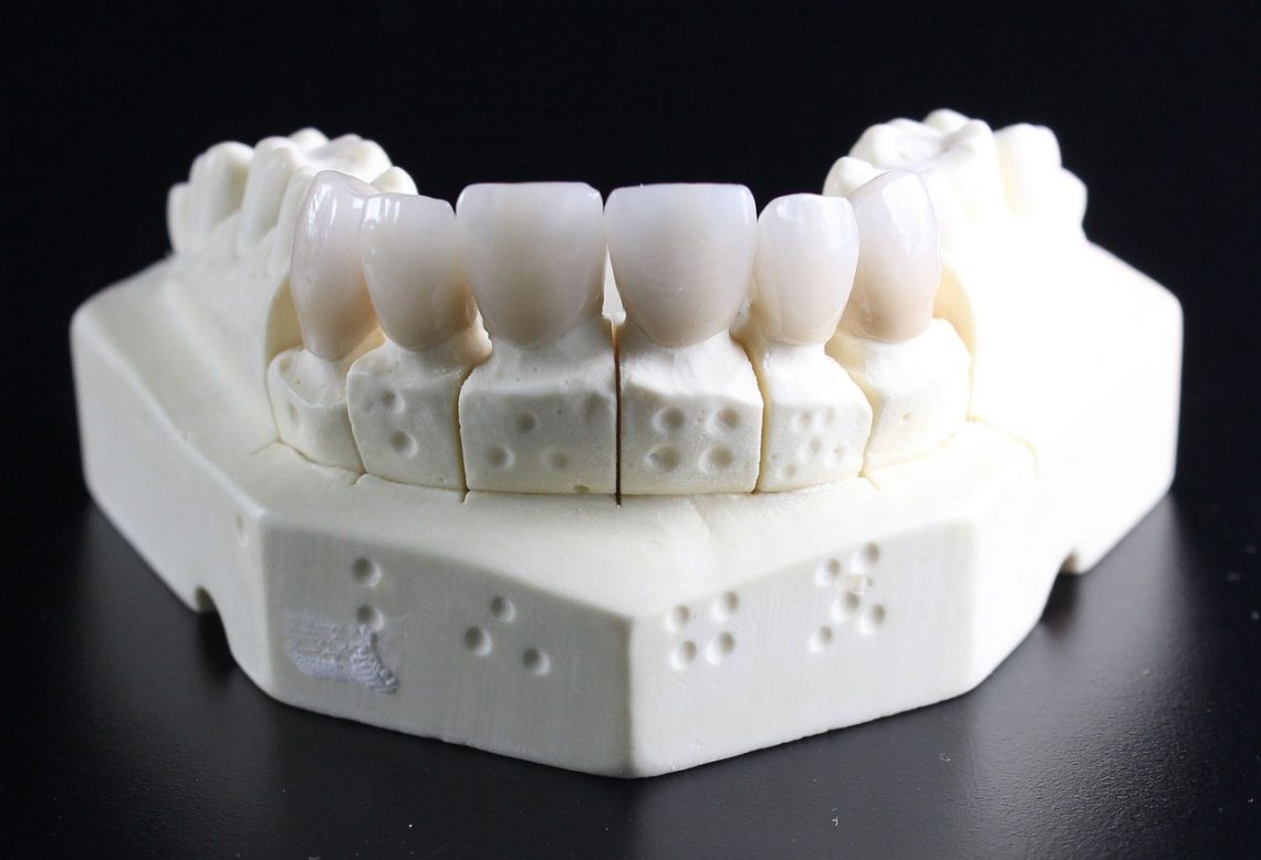 Improving Your Smile with Partial Dentures in Brisbane North